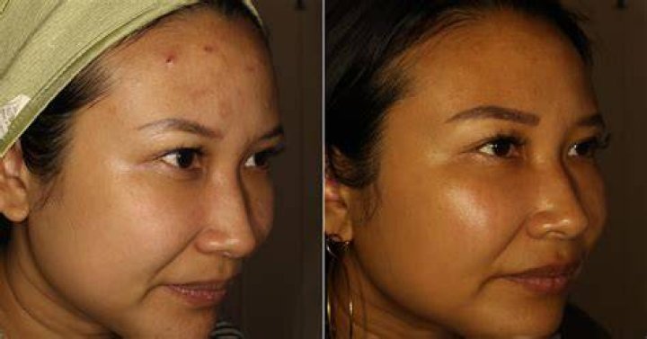 Bone Broth Skin Before And After