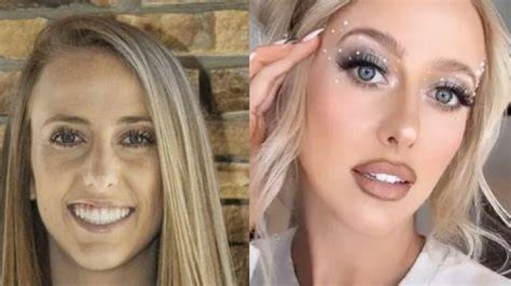 Brittany Mahomes’ Plastic Surgery: Did She Get Lip Fillers and Breast Implants?