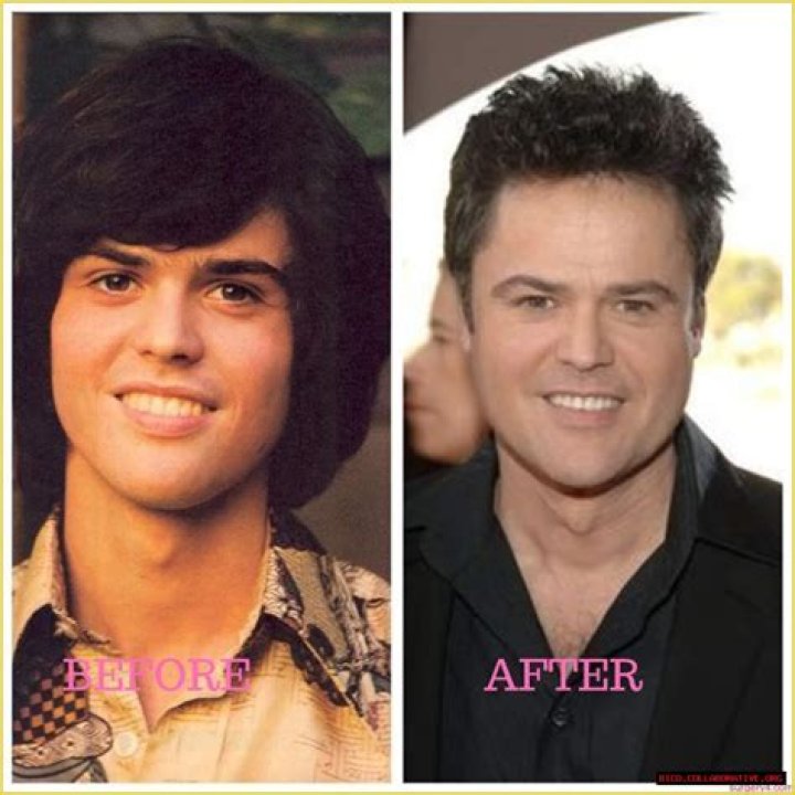 Donny Osmond's Plastic Surgery Journey Revealed