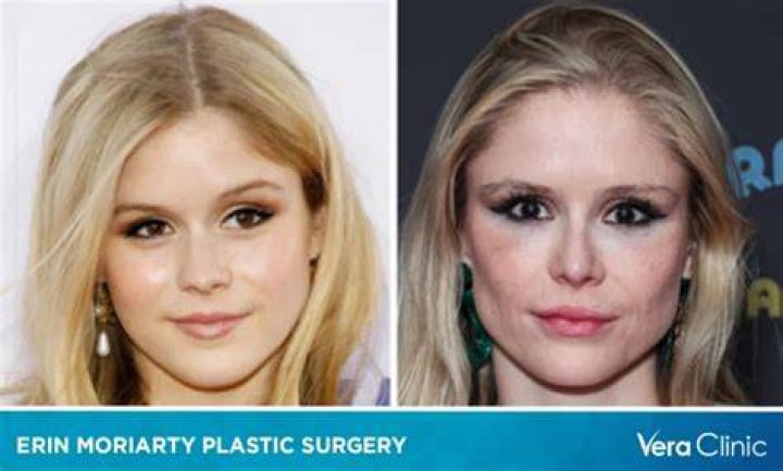 Erin Moriarty's Cosmetic Surgery Journey Explored
