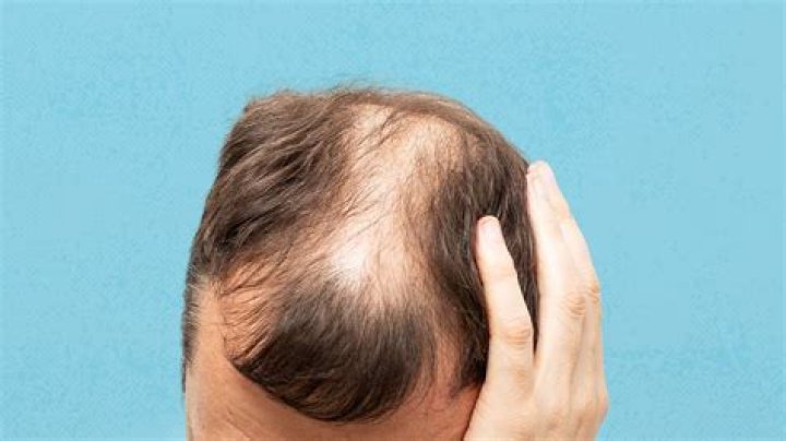 Joey Logano Hair Piecedetails Alopecia And Hair