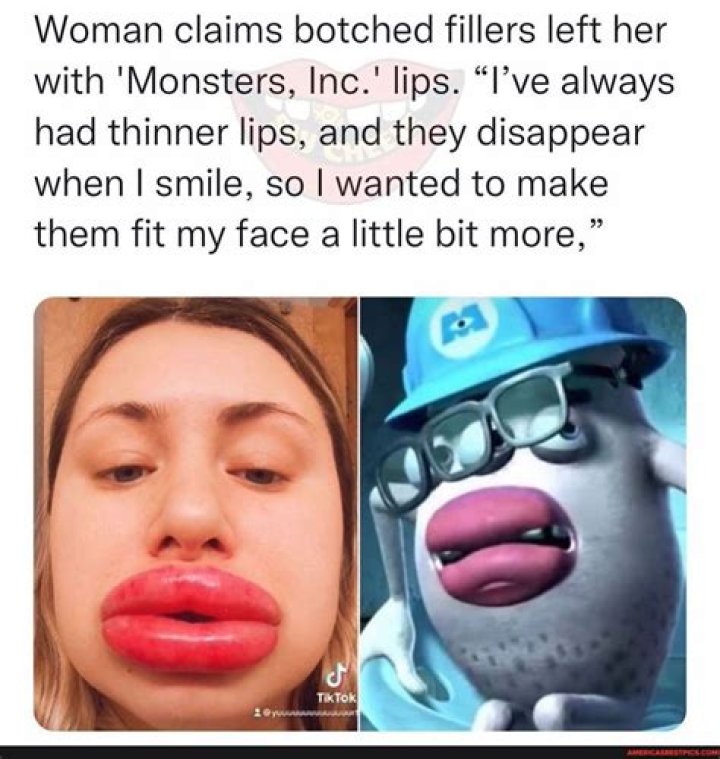 Woman claims botched fillers left her with 'Monsters, Inc.' lips ·